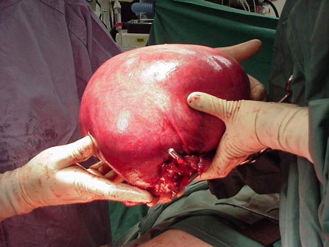 large fibroid removed